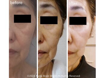 スキンラボ 新宿(@SkinLabo)/WIQO水光コラーゲンピーリング