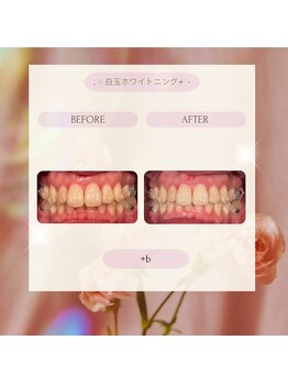 プラスビー 2号店(+b)/ホワイトニングビフォーアフター