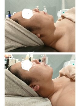 ソウナ(SONA)/プラスマ×EMS×テラヘルツ