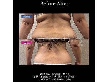 リノアドット(LiNOA.)の写真/【ラジオ波 × キャビ × 吸引 × EMS】の最強コンボ！“温める・分解・流す・引き締める” を一度に★