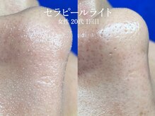 エイトスキン(8skin)/韓国発セラピール(毛穴洗浄付)