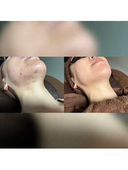 パシテア(Pasithea)の写真/長年のお悩みを解決!シミ・シワ・毛穴・赤ら顔・ハリと総合的な肌質改善に◎