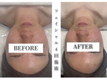 リアレント 高槻店(Lialent)の雰囲気（インディバフェイシャルで理想のお顔へ◆リフトアップ◆シワ改善）
