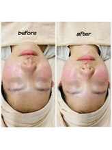 KMB 恵比寿店/毛穴洗浄＋光＋炭酸ガスパック