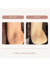 シュエット(Chouette)/ワキ脱毛 before after