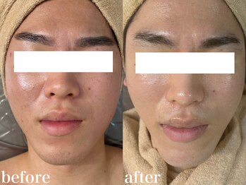 ホワイトアクア 北千住店(WHITE AQUA)/ハーブピーリング1回/毛穴改善