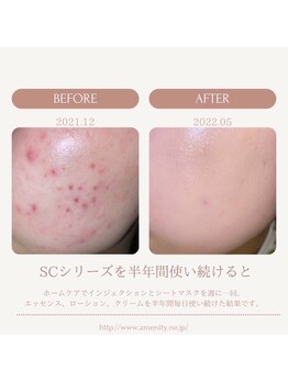 ジュノー ビューティー 綾瀬店(Juno Beauty)/毛穴/ハーブピーリング/エステ