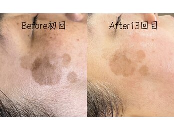 エリア(area.)/5、【シミケア25分】