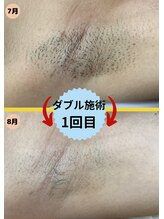 ディスイズミー シュガーリング(This is me Sugaring)/【ダブル】カミソリ不要で光脱毛