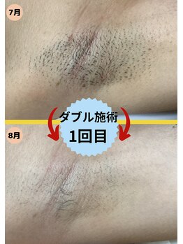 ディスイズミー シュガーリング(This is me Sugaring)/【ダブル】カミソリ不要で光脱毛