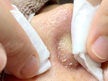 ジューンブライド(June Bride 61)の写真/毛穴悩みの方必見☆肌のプロ!エステティシャンが選ぶ【毛穴洗浄】は圧倒的ビフォアフターが話題のこちら!