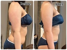 ルアナ(Luana)/《脂肪冷却》二の腕スッキリ！