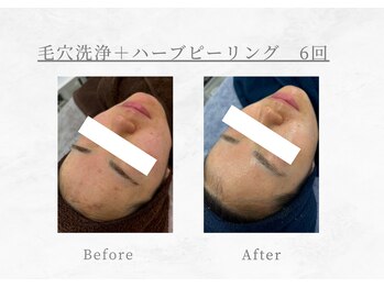 エヴァーグレース 三河安城店(EVER GRACE)/【肌管理】毛穴洗浄＋ハーブ