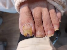 爪切り屋 足楽/肥厚爪