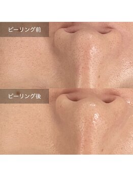 トニック バイ まつもと整骨院鍼灸院(Tonic)/★小鼻BeforeAfter★ 豊中/毛穴