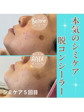 クリニカルココ 香椎店(クリニカルCOCO)/シミケア＆ララピール