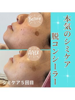 クリニカルココ 香椎店(クリニカルCOCO)/シミケア＆ララピール