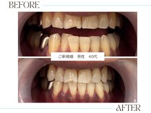 ホワイトニングサロンブライト 尼崎店(Whitening salon bright)/ご新規様のbefore/after