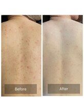 アーユルヴェーダアンドアロマエステ アユス(AYUS)/ハーブピーリング背中