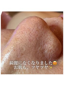 リエラ(Liella)/廿日市で小鼻のむくみもスッキリ