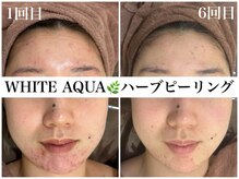 ホワイトアクア 梅田本店(WHITE AQUA)/ハーブピーリング/ニキビケア