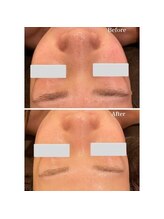 エノアビューティー(ENOA beauty)/毛穴開き・皮脂づまり解消