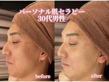 アクトベレッザ(Act BELLEZZA)/肌セラピーで白玉毛穴レス肌に