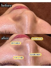 ニューズビューティー(neu's beauty)/フェイシャル × ハイドロ洗浄☆