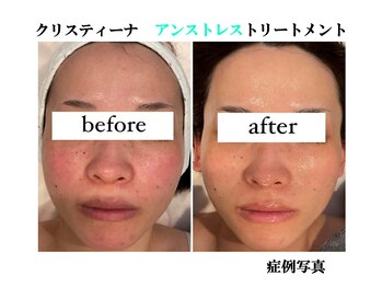 マーガレット(Marguerite)/CHRISTINA 乳酸菌ピーリング