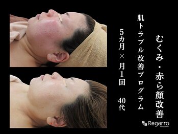 レガロビューティクリエイションズ桜川店/もう悩まない！肌荒れ改善