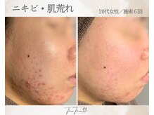 スリースリー(THREE THREE)/ニキビ・肌荒れケア