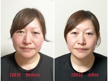 シルフィード/たるみリフトアップ