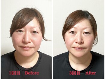 シルフィード/たるみリフトアップ