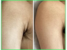 クリア 尾張旭店(Clear)/【Clear脱毛ビフォーアフター】