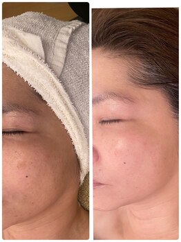 ステラフィールド(stella field)/光フェイシャル　施術3回目