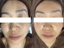 クリスタル(Crystal)/長年悩んだシミにもしっかり排出