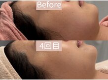 ベアール(beal)/小顔矯正×リフトアップ機械4回