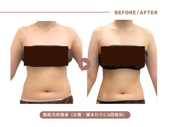 イエス マイサロン(yes My Salon)/脂肪冷却施術例