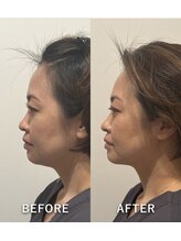 メディカルエース(MedicalAce)/プレミアムブライティングリフト