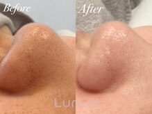 ルノン(Lunon)/毛穴洗浄ハイドロ×ララピール