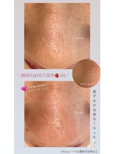 クレヴィー(Creviy)/韓国式3D毛穴洗浄1回