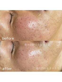 ビジュープラス 松本店(Bijou+)/ハーブピーリング