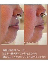 シャンディ(Shandy)/松ヤニエステ&エクソソーム導入