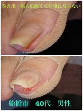 巻き爪じゅん 千葉駅前店/陥入爪が痛くて仕事にならない!