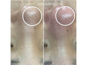 ピエル 北千住店(PIEL)/剥がす毛穴パックやめてください