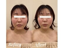 シェリール(Cherir)/小顔矯正