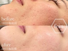 フェイン 青山店(fein.)/お肌の凹凸などのケアにも♪