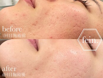 フェイン 青山店(fein.)/お肌の凹凸などのケアにも♪