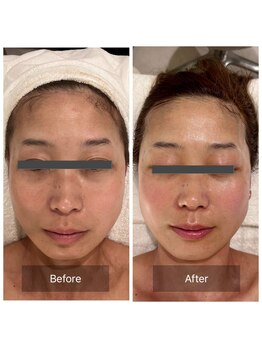 マインエム(mine.m)/ダイヤモンドピーリング