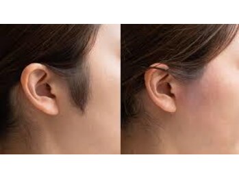 シュガーリングハウスレディ(SugaringHouse LADY)/もみあげ脱毛